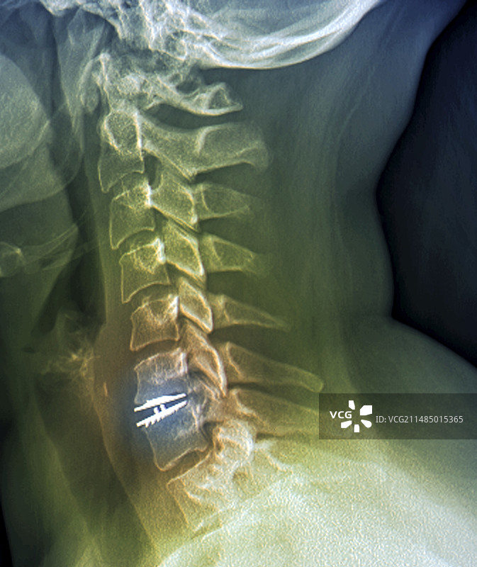 椎间盘植入X光片图片素材