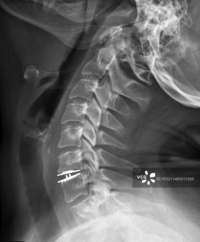椎间盘植入X光片图片素材