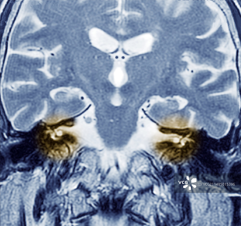 听觉系统核磁共振成像图片素材