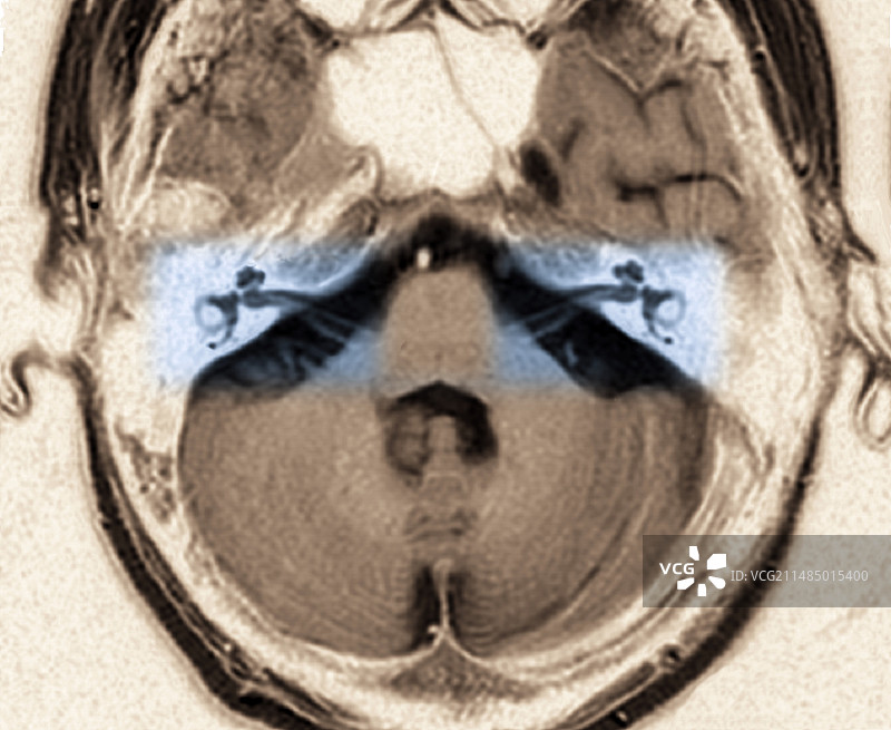 听觉系统核磁共振成像图片素材
