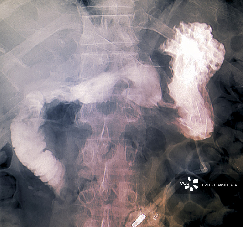 癌症中的胃饲管X光片图片素材