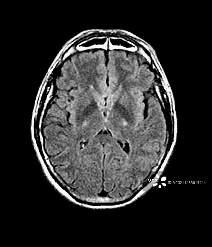 运动神经元疾病患者的脑部核磁共振成像图片素材