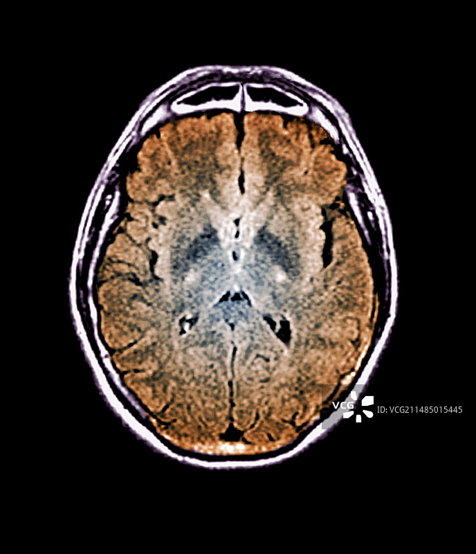 运动神经元疾病患者的脑部核磁共振成像图片素材