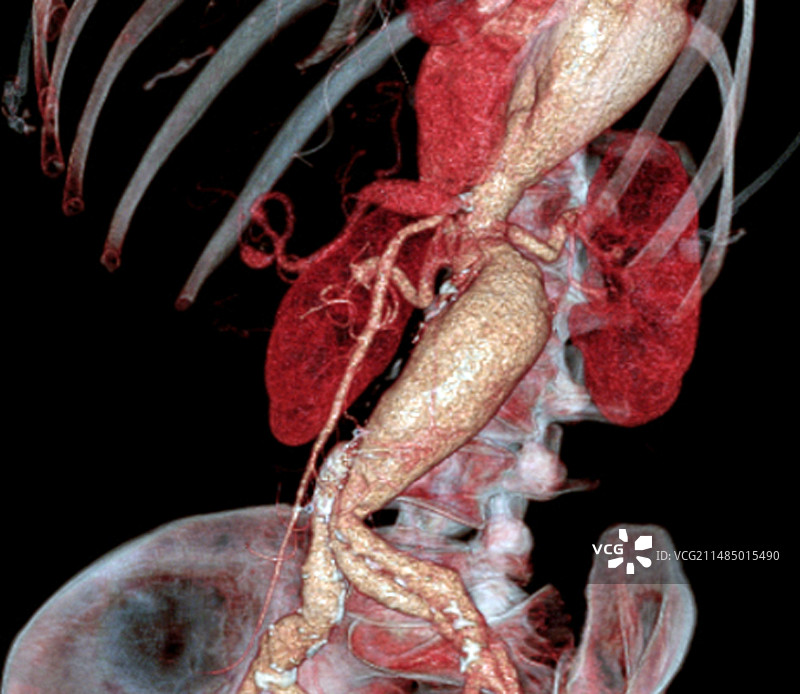 马凡综合征动脉瘤CT图片素材