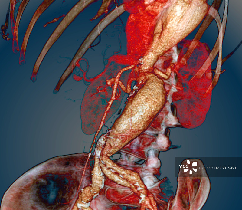 马凡综合征动脉瘤CT图片素材