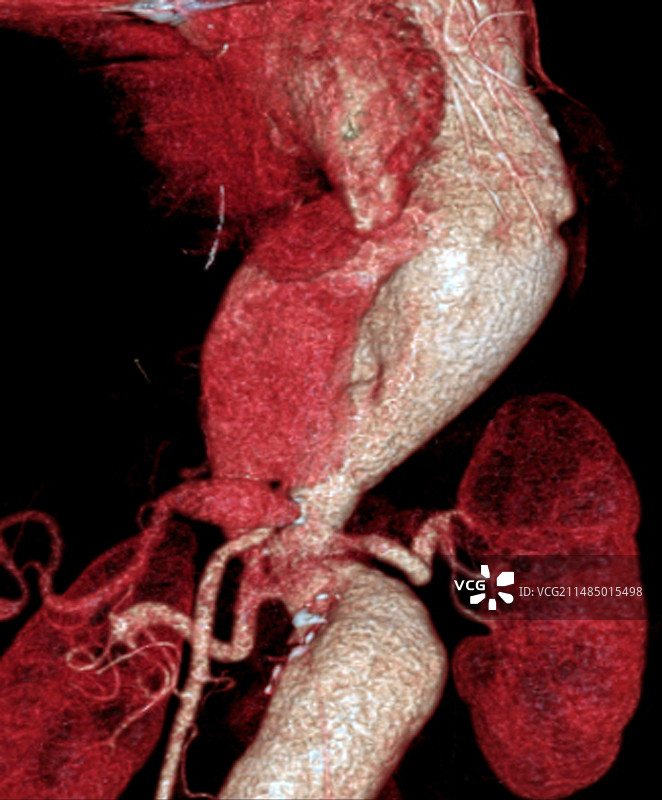 马凡综合征动脉瘤CT图片素材