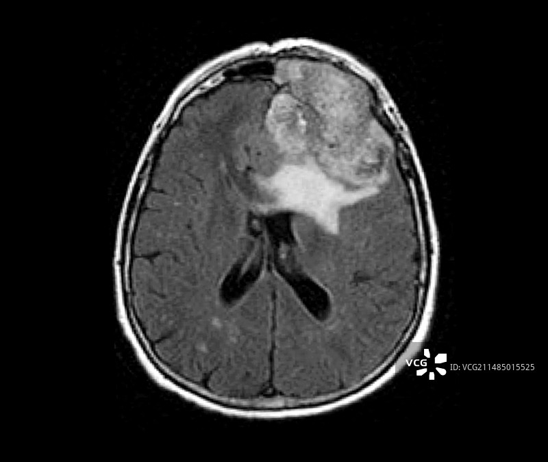 脑癌，MRI图片素材