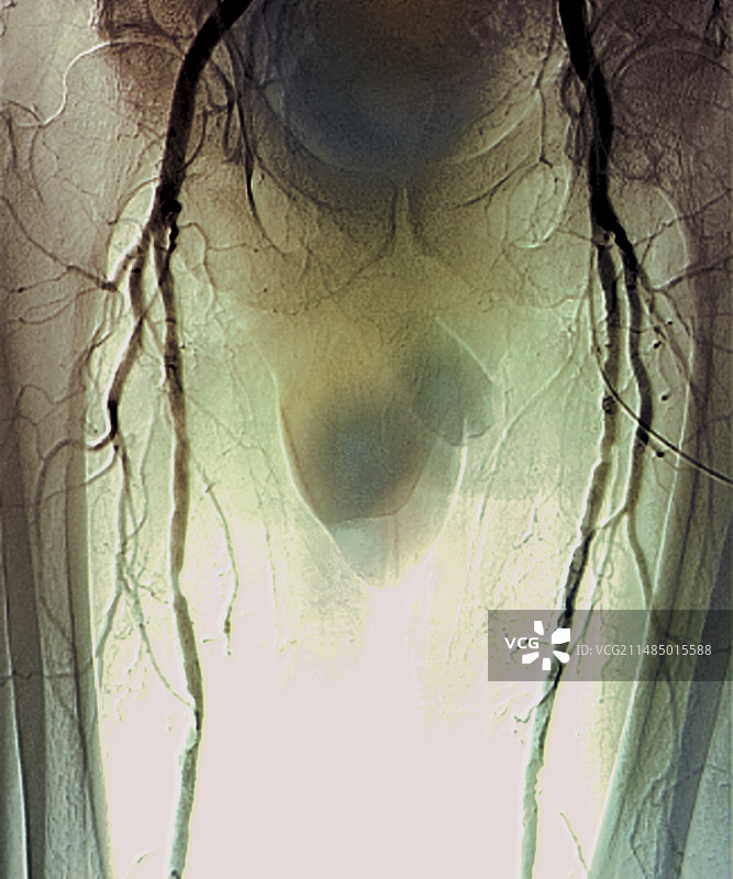 糖尿病性动脉炎X光片图片素材