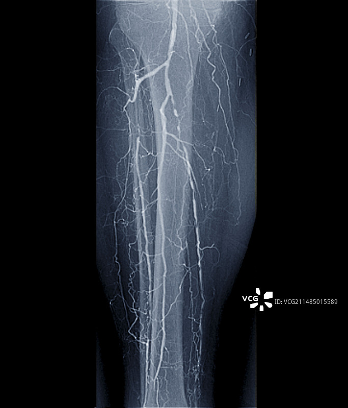 糖尿病性动脉炎X光片图片素材