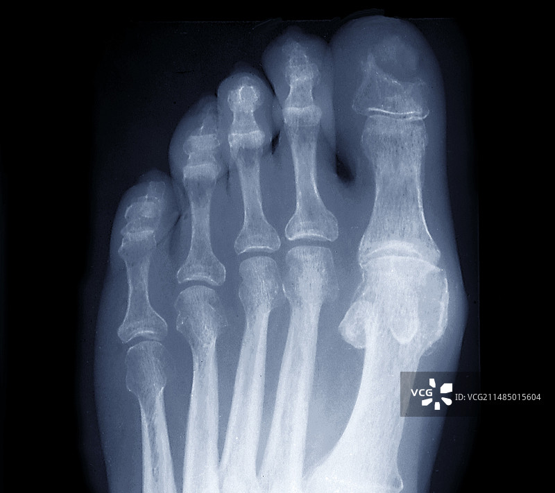 糖尿病性骨坏死X光片图片素材