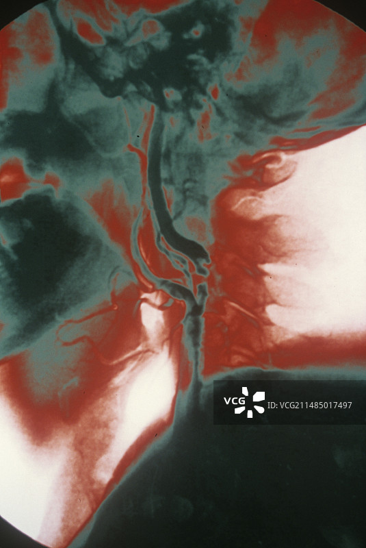 颈动脉粥样硬化X光片图片素材