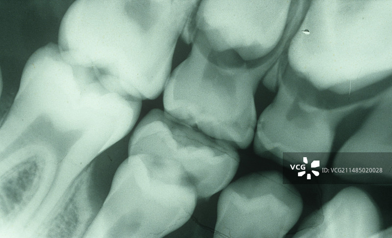 牙科X光检查（6岁儿童）图片素材