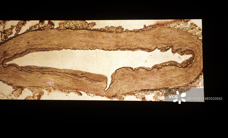 发炎的动脉，光学显微照片图片素材