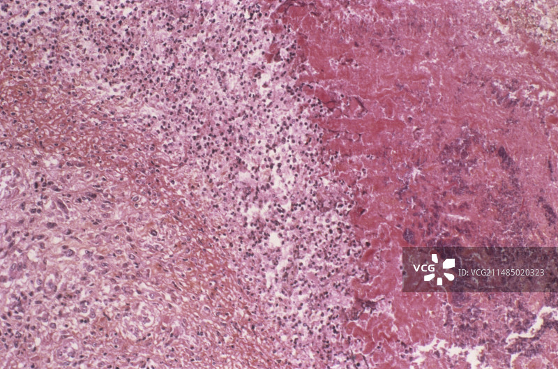 心内膜炎，显微照片图片素材