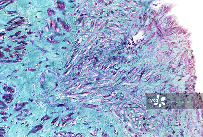 静脉曲张，光学显微照片图片素材