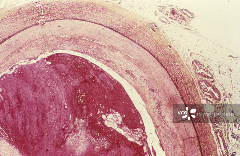 糖尿病动脉炎显微照片图片素材