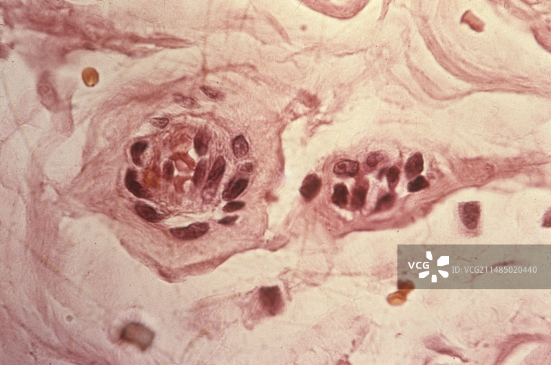 莫顿神经瘤显微照片图片素材