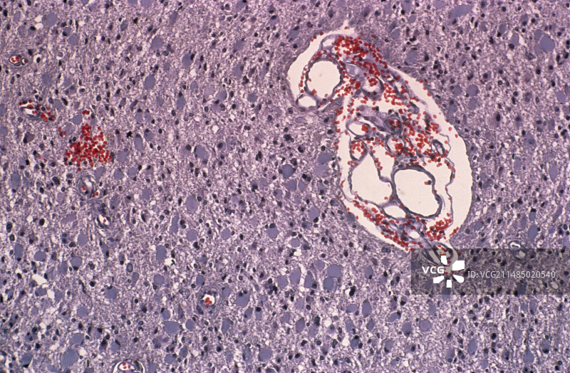 脑癌，光学显微照片图片素材
