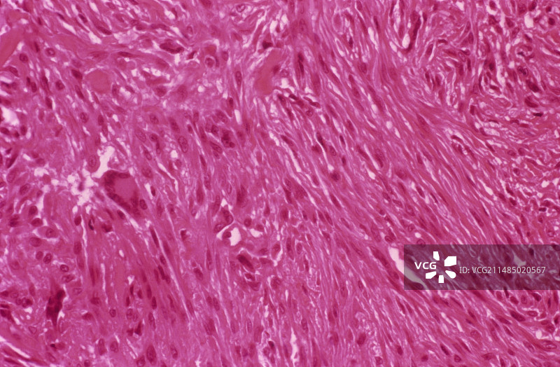 纤维组织细胞瘤，显微照片图片素材