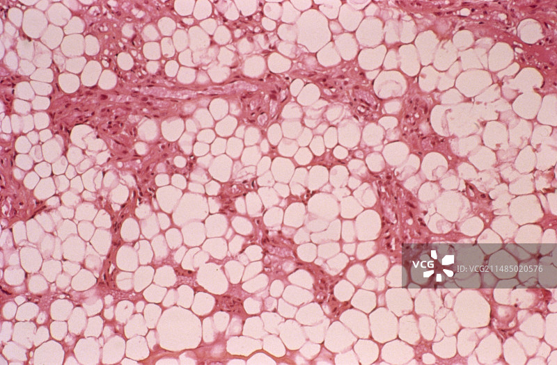 脂肪瘤显微照片图片素材