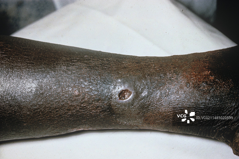 慢性静脉疾病图片素材