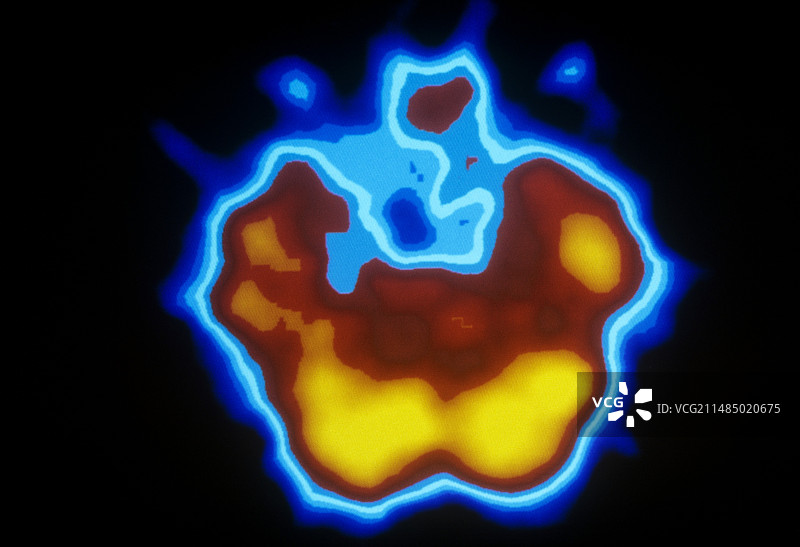 癫痫患者的脑部活动SPECT扫描图片素材