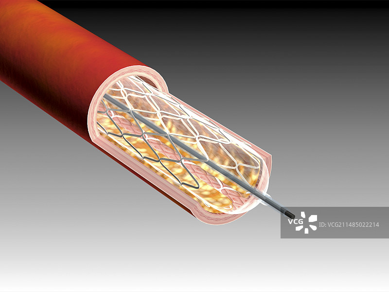 冠状动脉血管成形术插画图片素材