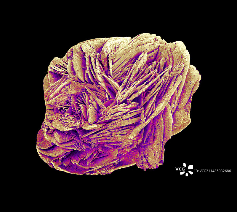 肾结石，扫描电镜图片素材