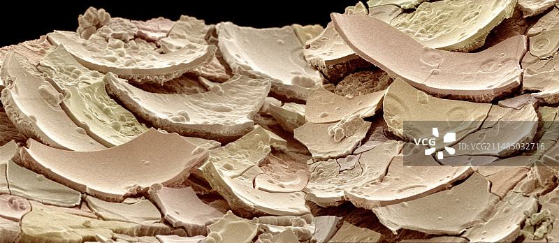 肾结石，扫描电镜图片素材