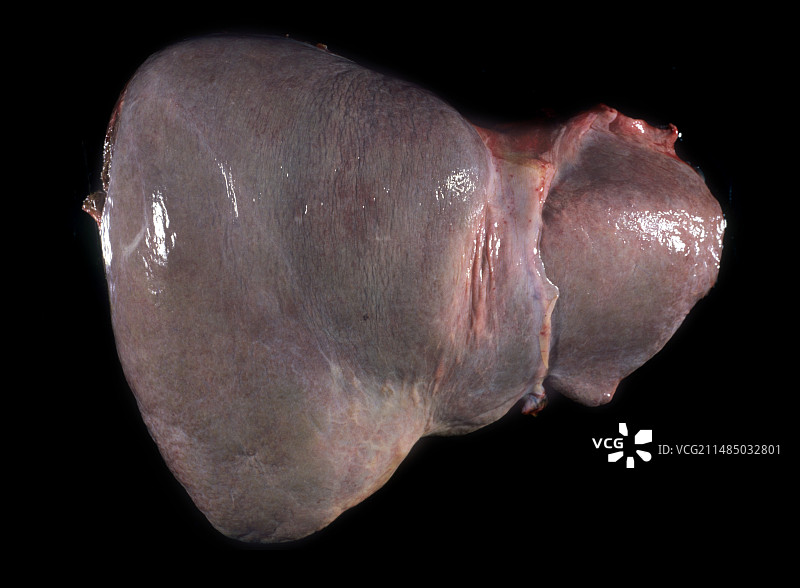 肝脏病理标本图片素材