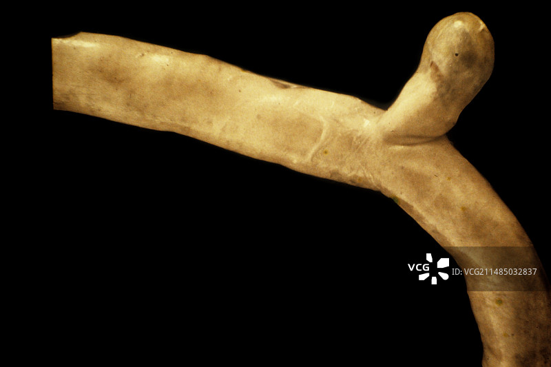 麦克尔憩室图片素材