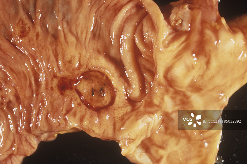 十二指肠溃疡伴动脉破裂图片素材
