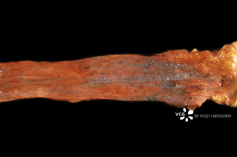 食管静脉曲张图片素材