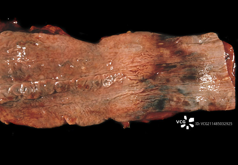 食管静脉曲张图片素材