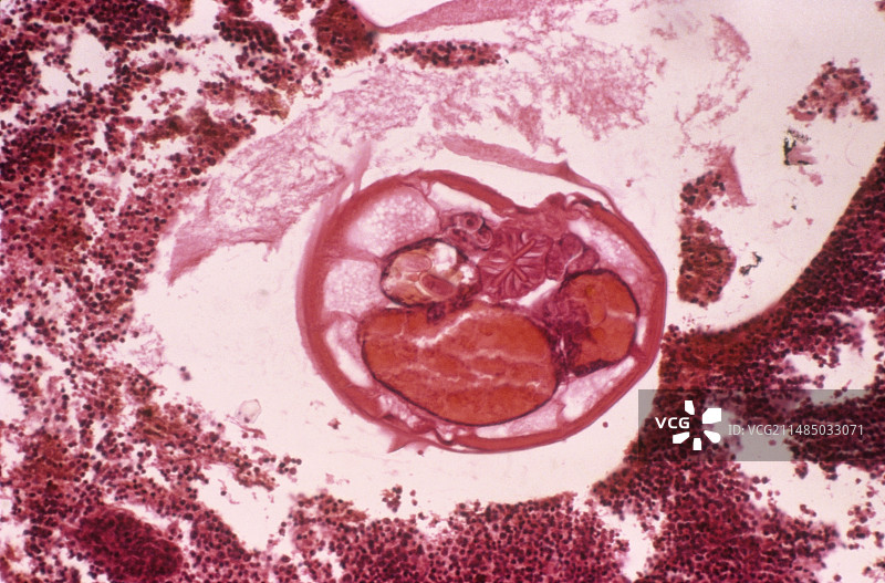 阑尾的蛲虫感染图片素材