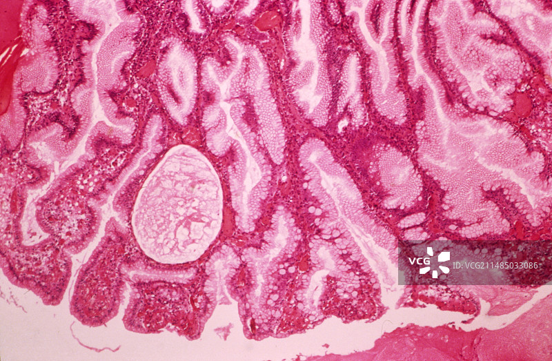 胃息肉，光学显微照片图片素材