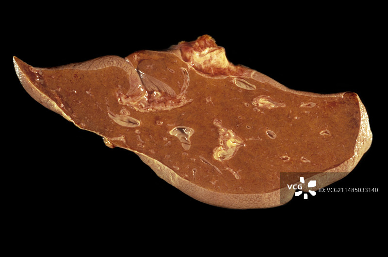 暴发性肝炎图片素材