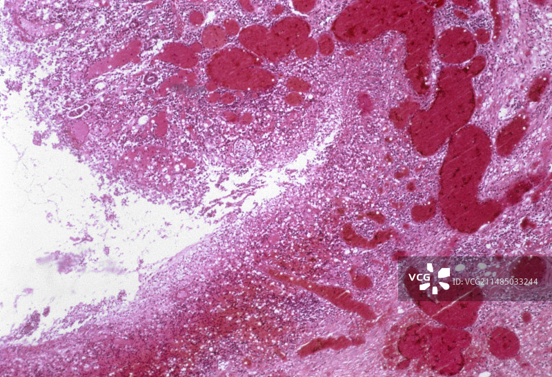 结肠发炎，光学显微照片图片素材