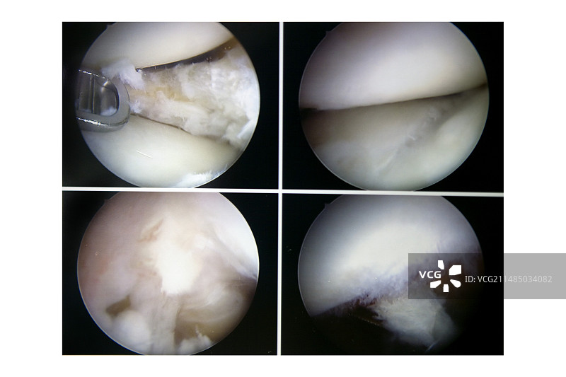 膝关节软骨撕裂关节镜检查图片素材