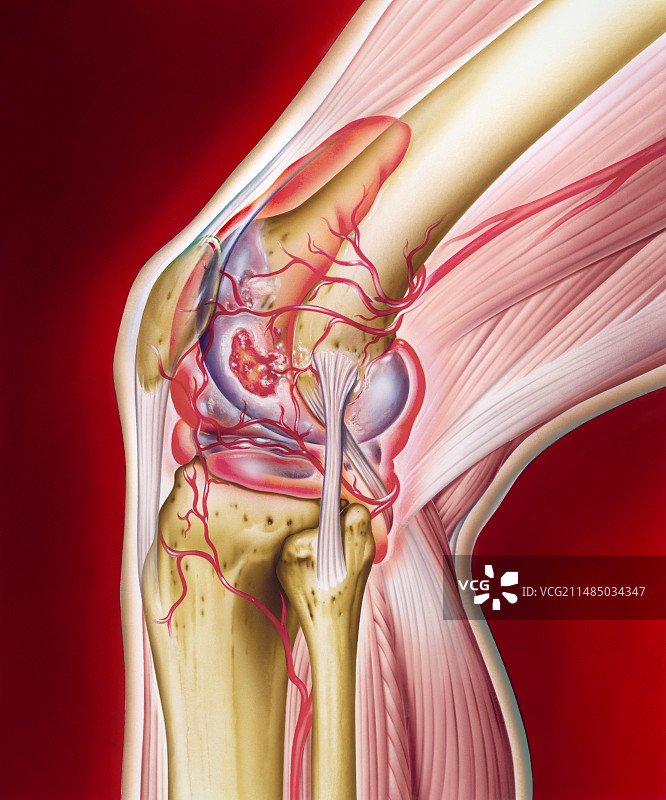 类风湿性关节炎膝盖图片素材