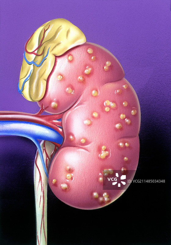 急性肾盂肾炎艺术图图片素材