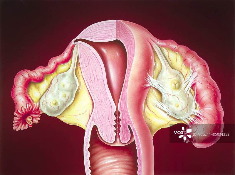 输卵管炎症，艺术作品图片素材