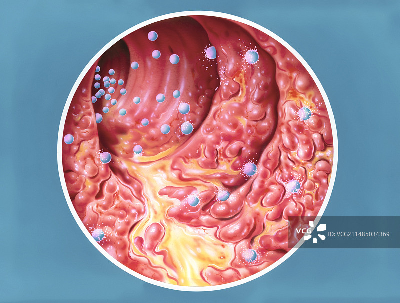 溃疡性结肠炎治疗医学插图图片素材