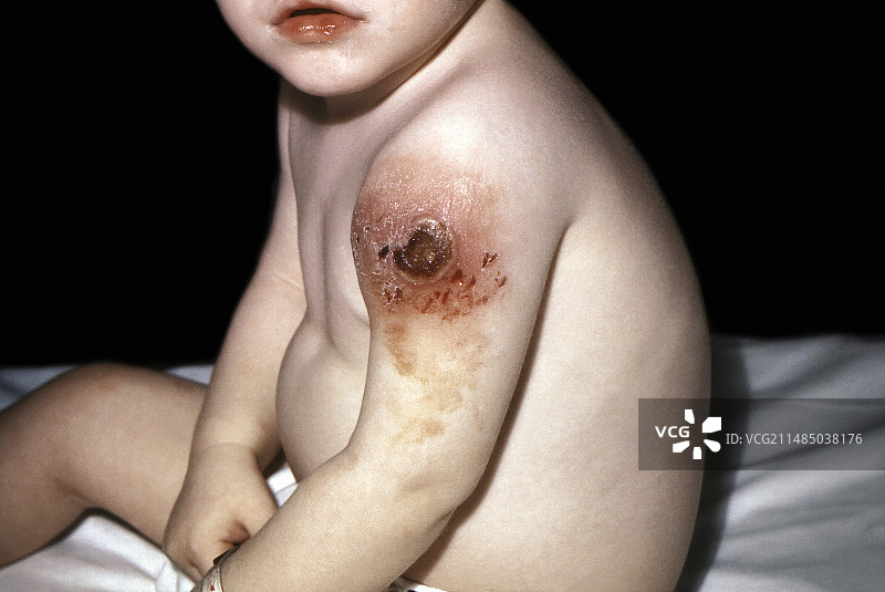 1968年儿童低丙种球蛋白血症图片素材