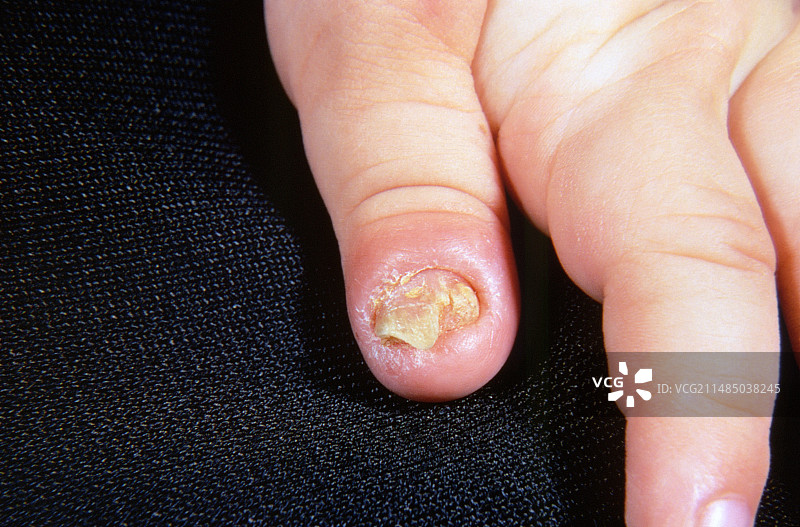 念珠菌皮肤感染图片素材