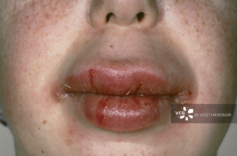 克罗恩病引起的口腔肿胀图片素材