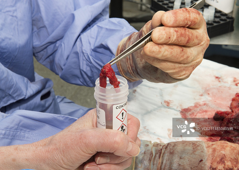 食管胃切除术图片素材