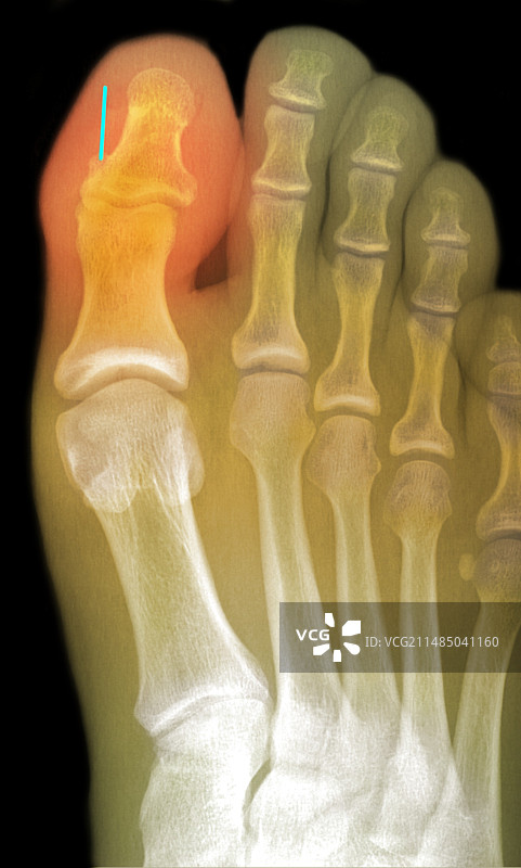 脚趾X光片，针头刺入脚趾图片素材