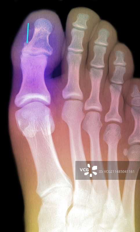 脚趾X光片，针头刺入脚趾图片素材