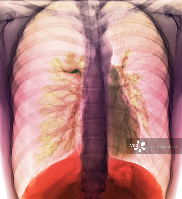 气胸，X光片图片素材